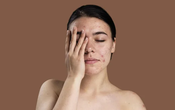 Treatment Of Acne and Pimples