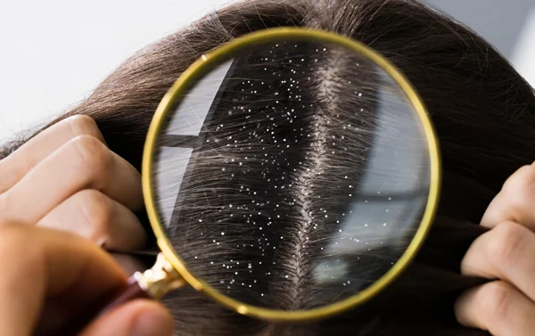 Treatment of Dandruff